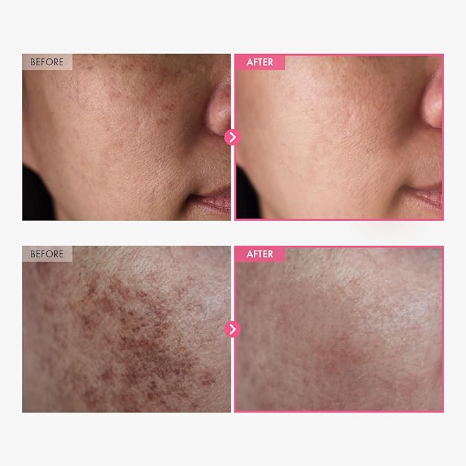 Meesue Arbutin 7% & Tranexamic Acid 4% Cream with Niacinamide for Dark Spots & Pigmentation