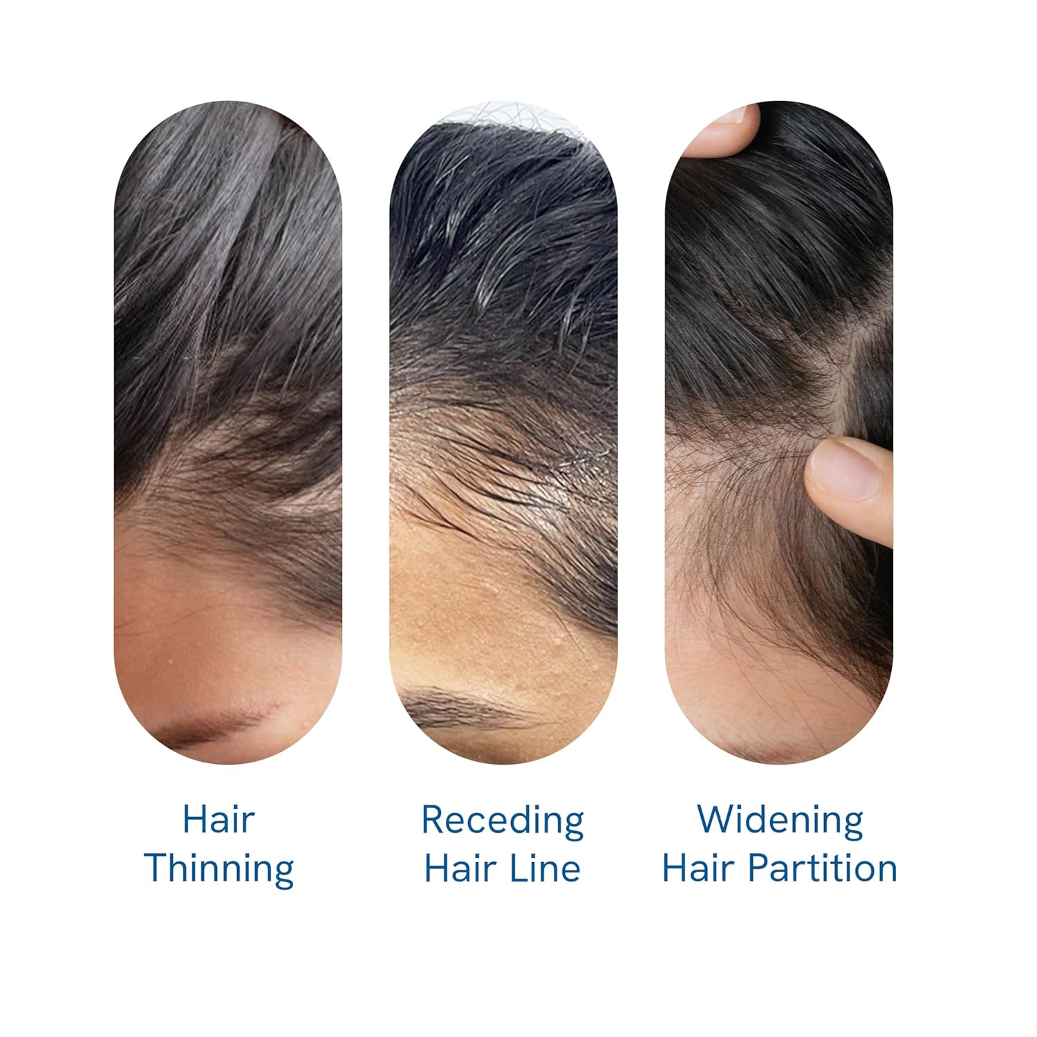 Meesue Hair Growth Serum Roll-On with Rosemary, Redensyl & Peptides