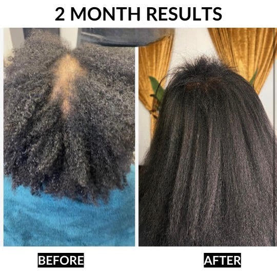 Meesue Healthy Hair Starter Kit 6-Piece Complete Hair Care Bundle for Stronger Hair